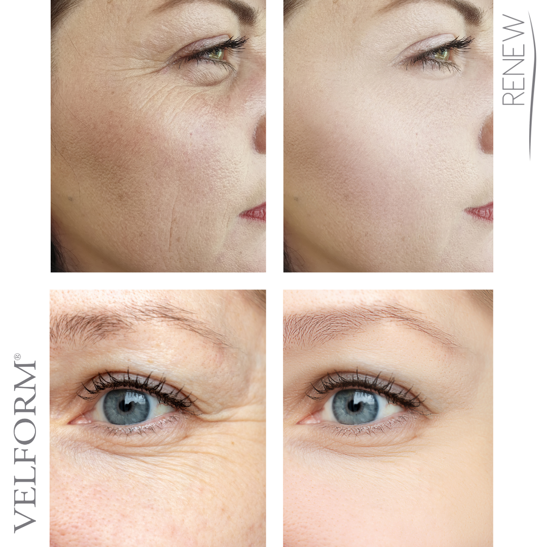 Tratamiento Facial Antiaging con Colágeno y Ácido Hialurónico